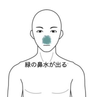 鍼灸の症例「風邪後に続く緑色の鼻水と鼻の奥の痛み」（群馬県伊勢崎市）