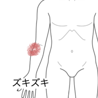 鍼灸の症例「テニスの練習中に肘を痛めた」（群馬県伊勢崎市）