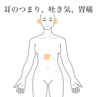 鍼灸の症例「繰り返す両耳の詰まりと吐き気」（有松駅）