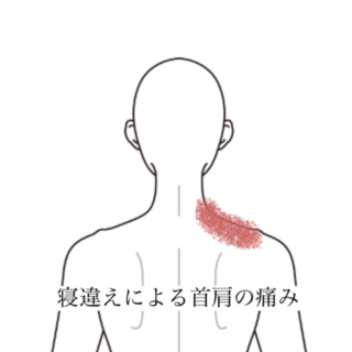 鍼灸の症例「朝起きたら首が痛くて回らない寝違い」（群馬県伊勢崎市）