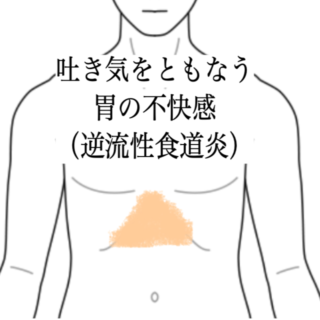 鍼灸の症例「吐き気をともなう胃の不快感（逆流性食道炎）に対する施術例」（島根県出雲市）