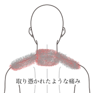 鍼灸の症例「何もしていなくても気になる首の痛み」（群馬県伊勢崎市）