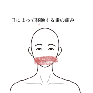 鍼灸の症例「日によって移動する歯の痛み」（神戸市須磨区）