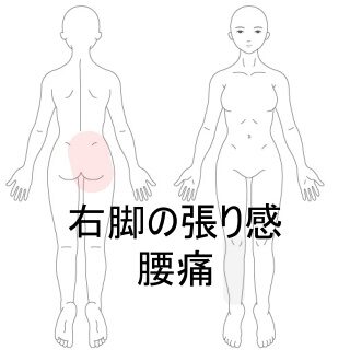 鍼灸の症例「雪かき後の右腰痛と下肢の重怠さ」（東室蘭駅）