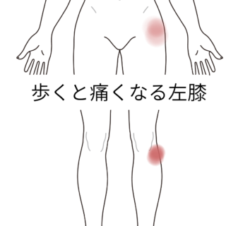 歩くと痛くなる左膝