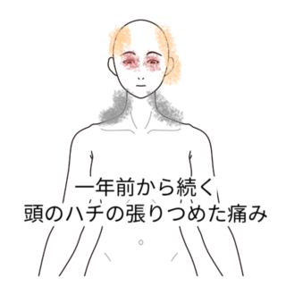 鍼灸の症例「耳鳴りと目の奥、こめかみ、頭のハチの痛み」（名鉄桜井駅/愛知県安城市）