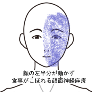 鍼灸の症例「顔の左半分が動かず食事がこぼれる顔面神経麻痺」（阪急三国駅/大阪市淀川区）