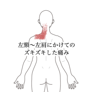 鍼灸の症例「左頸〜左肩痛の症例　約6ヶ月の経過報告」（沖縄県那覇市）