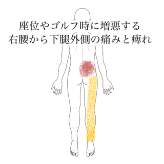 鍼灸の症例「座位やゴルフ時に増悪する右腰から下腿外側の痛みと痺れ」（清澄白河）