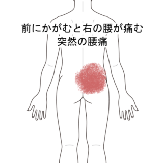 鍼灸の症例「前にかがむと右の腰が痛む突然の腰痛」（阪急三国駅/大阪市淀川区）