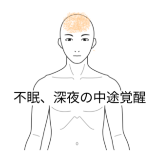鍼灸の症例「半年以上続く中途覚醒」（勝田駅）