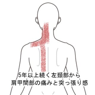 鍼灸の症例「5年以上続く左頚部から肩甲間部の痛みと突っ張り感」（阪急三国駅/大阪市淀川区）