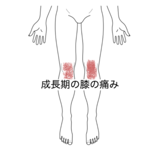 鍼灸の症例「成長期の膝の痛み」（清澄白河）