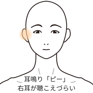 鍼灸の症例「耳鳴りの翌朝から聴こえづらくなった」（JR千里丘駅／大阪府吹田市）