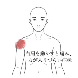 鍼灸の症例「右肩を動かすと痛み、力が入りづらい症状」（清澄白河）