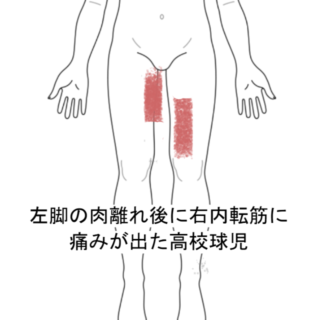 鍼灸の症例「左脚の肉離れ後に右内転筋に痛みが出た高校球児」（阪急三国駅/大阪市淀川区）
