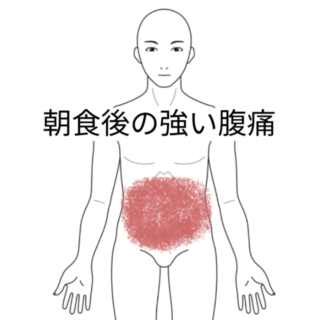 鍼灸の症例「午前中強い痛みを伴う過敏性腸症候群」（勝田駅）