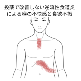 鍼灸の症例「投薬で改善しない逆流性食道炎による喉の不快感と食欲不振」（名古屋市営地下鉄　東山線　池下駅/名古屋市千種区）