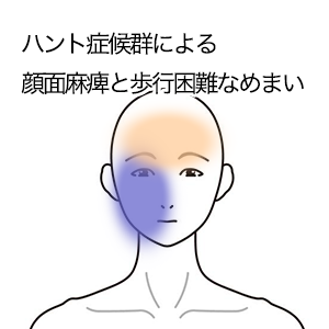 鍼灸の症例「ハント症候群による顔面麻痺と歩行困難なめまい」（西武新宿線「本川越駅」徒歩5分　/　埼玉県川越市）