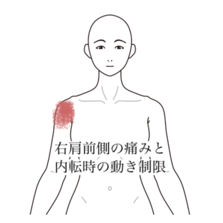 鍼灸の症例「右肩前側の痛みと内転時の動き制限」（清澄白河）