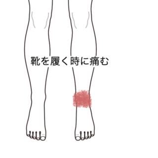 鍼灸の症例「靴を履くときに痛む左足首」（群馬県伊勢崎市）