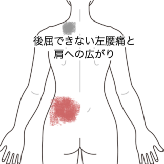 鍼灸の症例「後屈できない左腰痛と肩への広がり」（JR品川駅／東京都品川区）