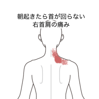 鍼灸の症例「朝起きたら首が回らない右首肩の痛み」（JR品川駅／東京都品川区）