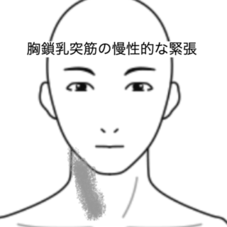 鍼灸の症例「胸鎖乳突筋の慢性的な緊張」（JR品川駅／東京都品川区）