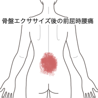 鍼灸の症例「骨盤エクササイズ後の前屈時腰痛」（JR品川駅／東京都品川区）