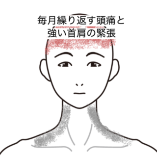 鍼灸の症例「毎月繰り返す頭痛と強い首肩の緊張」（JR品川駅／東京都品川区）