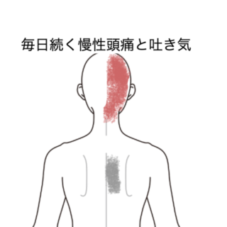 鍼灸の症例「毎日続く慢性頭痛と吐き気」（JR品川駅／東京都品川区）