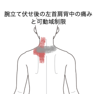 鍼灸の症例「腕立て伏せ後の左首肩背中の痛みと可動域制限」（JR品川駅／東京都品川区）