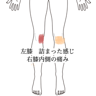 鍼灸の症例「左膝の違和感と右膝内側痛　約6ヶ月の経過」（沖縄県那覇市）