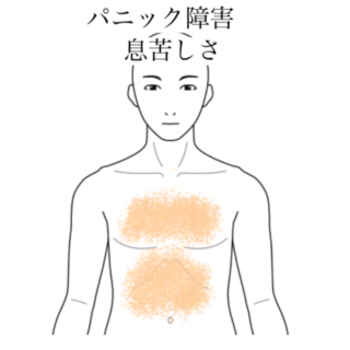 鍼灸の症例「仕事のストレスから始まった呼吸困難と胸部不快感」（有松駅）