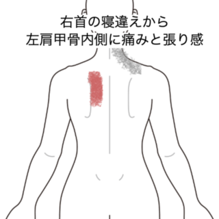鍼灸の症例「右首の寝違えから左肩甲骨内側に痛みと張り感」（JR品川駅／東京都品川区）