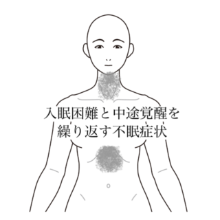 鍼灸の症例「入眠困難と中途覚醒を繰り返す不眠症状」（清澄白河）