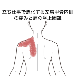 鍼灸の症例「立ち仕事で悪化する左肩甲骨内側の痛みと肩の挙上困難」（JR品川駅／東京都品川区）