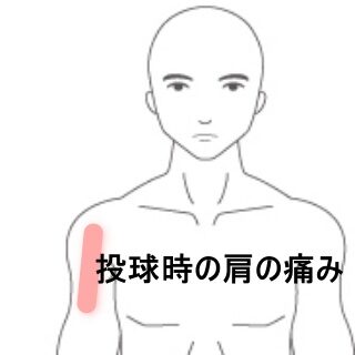 鍼灸の症例「フォロースルー期に右肩がズキッと痛む中学野球部員」（東室蘭駅）