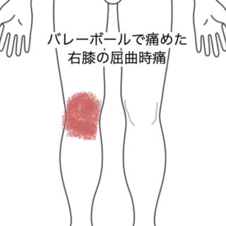鍼灸の症例「バレーボールで痛めた右膝の屈曲時痛」（JR品川駅／東京都品川区）