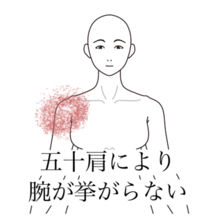 鍼灸の症例「突然動かなくなった左肩の可動域制限」（清澄白河）