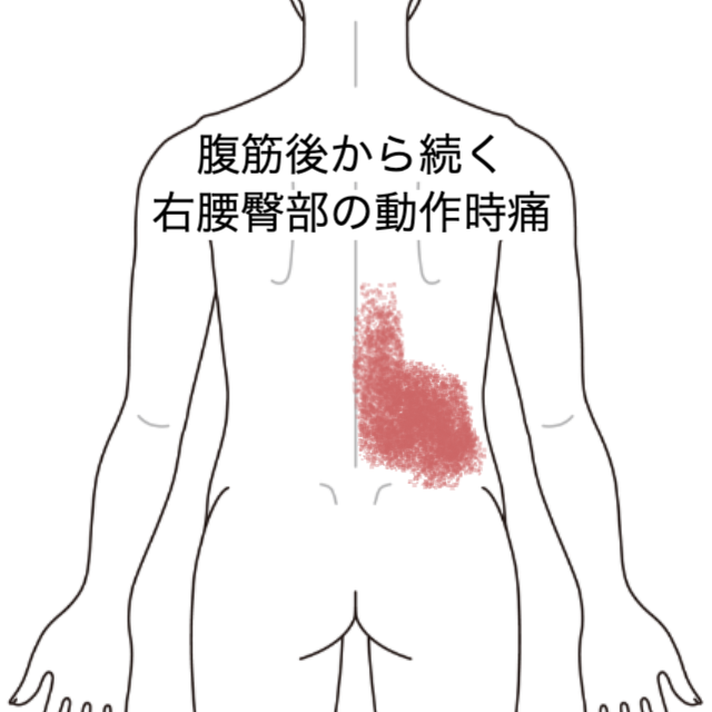 Pain in the right lower back and buttocks during movement, continuing ...