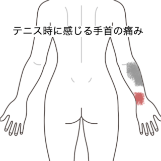 鍼灸の症例「テニス時に感じる手首の痛み」（JR品川駅／東京都品川区）