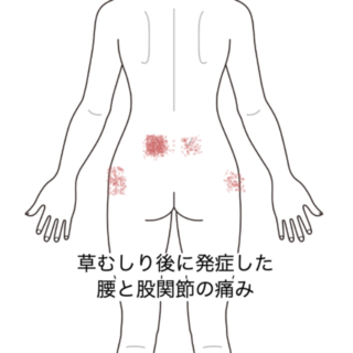 鍼灸の症例「草むしり後に発症した腰と股関節の痛み」（群馬県伊勢崎市）
