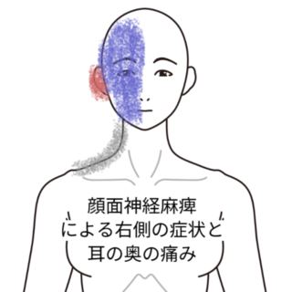 鍼灸の症例「右顔面の麻痺と食事後に悪化する耳の奥の痛み」（名鉄桜井駅/愛知県安城市）