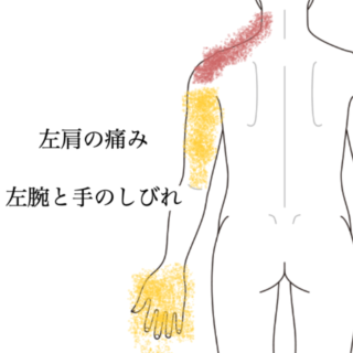 鍼灸の症例「動かすとひどくなる左肩の痛みと腕のしびれ」（神戸市須磨区）