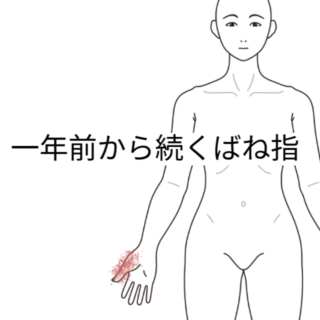鍼灸の症例「一年前からのばね指」（勝田駅）