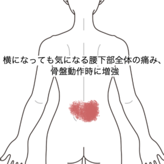 鍼灸の症例「横になっても気になる腰下部全体の痛み、骨盤動作時に増強」（JR品川駅／東京都品川区）