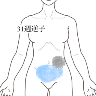 鍼灸の症例「妊娠31週の逆子と腰の重さ」（群馬県伊勢崎市）