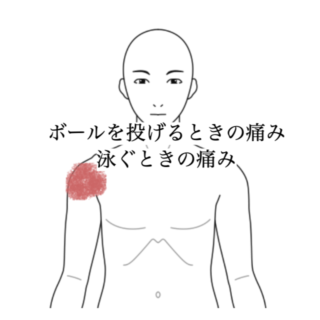 鍼灸の症例「右肩痛に対する鍼治療経過報告」（沖縄県那覇市）