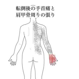 鍼灸の症例「転倒後の手首痛と肩甲骨周りの張り」（都営新宿線　船堀駅　/ 東京都江戸川区船堀）